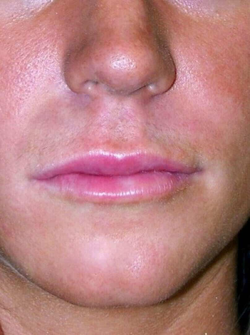 Close up of patient Amy's lips after lip lift surgery.