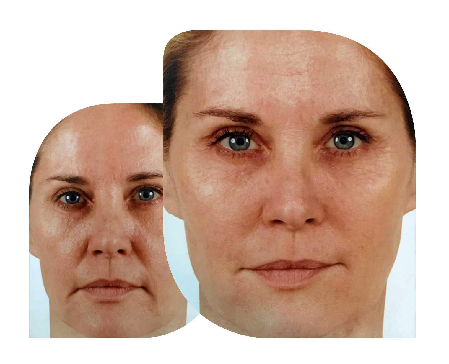Overlapping headshot photos of derma fillers patient before and after.