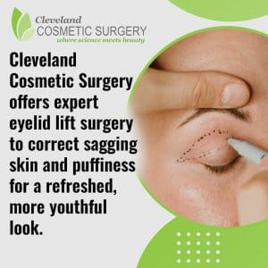 A close-up of a person's eye with dotted lines drawn by a marker, indicating preparation for an eyelid lift, with text about Cleveland Cosmetic Surgery's expertise in correcting sagging skin and puffiness.