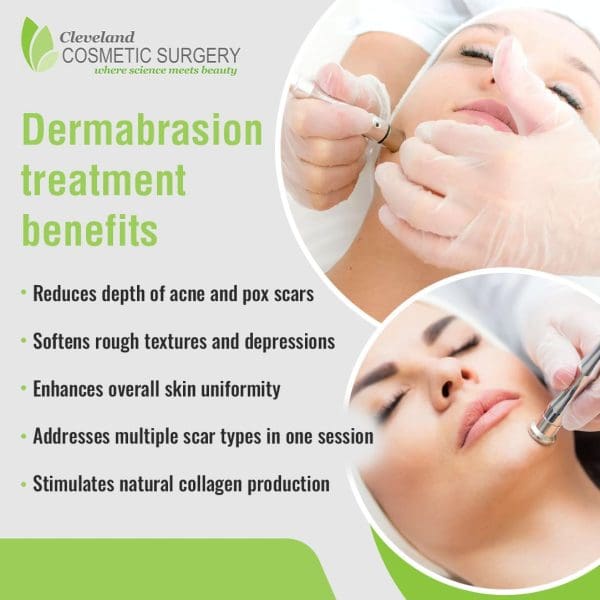 Two circular insets showing close-ups of a patient receiving a dermabrasion treatment, with the professional's gloved hand operating the device. Text lists dermabrasion treatment benefits, including reducing acne/pox scars, softening textures, enhancing uniformity, addressing multiple scar types, and stimulating collagen. Cleveland Cosmetic Surgery logo visible.