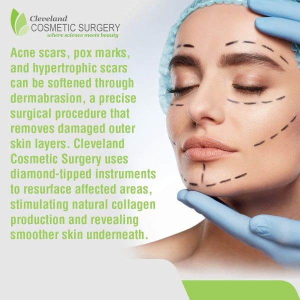 A woman with surgical markings on her face and a cap, with a gloved hand gently touching her chin. Text describes dermabrasion as a precise surgical procedure by Cleveland Cosmetic Surgery to soften acne, pox, and hypertrophic scars by removing damaged skin layers and stimulating collagen. Cleveland Cosmetic Surgery logo visible.
