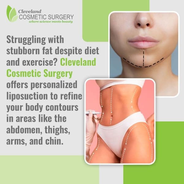 An advertisement for personalized liposuction at Cleveland Cosmetic Surgery. The image features a close-up of a woman's chin and a full body shot with surgical markings indicating areas for liposuction like the abdomen, thighs, and chin.