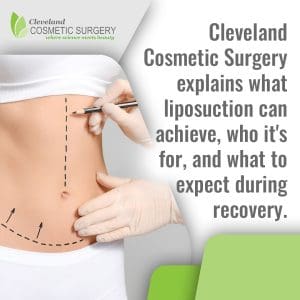 Surgeon marking abdomen and waist area for liposuction to target stubborn fat and improve body contour at Cleveland Cosmetic Surgery.