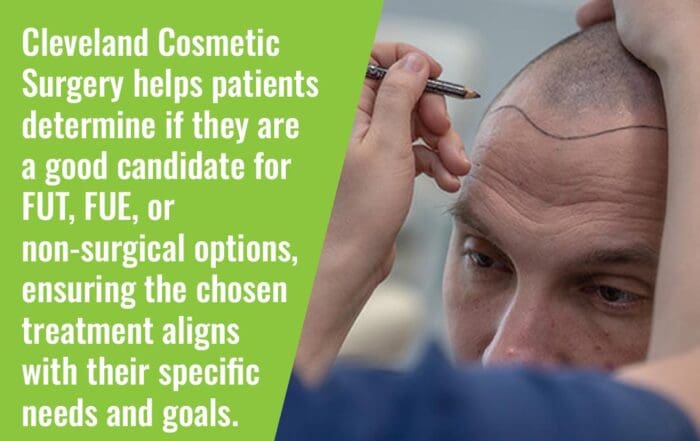 Surgeon marking hairline for hair transplant consultation including FUT and FUE options
