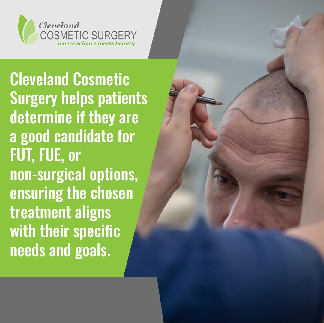 Surgeon marking hairline for hair transplant consultation including FUT and FUE options